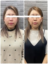 長寿鍼灸院 長寿整骨院/美容鍼50本の効果★小顔効果