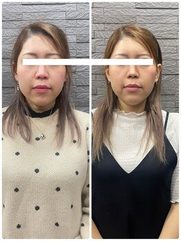 長寿鍼灸院 長寿整骨院/美容鍼50本の効果★小顔効果