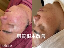 ネオリー(neorii)/毛穴洗浄＋ハーブピーリング