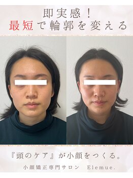 エレミュー(Elemue)/ビフォーアフター