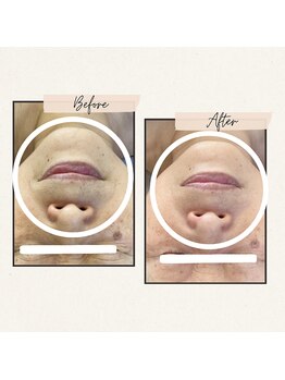 ルルーディア(LOULOUDIA)/お口周りのシワ改善へ！