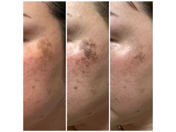 メルシー(merci)/光フェイシャル×ララピール