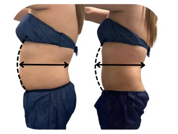 ココカラ(COCOKARA)/脂肪冷却で見た目マイナス10kg