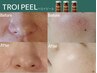 【トロイピール】毛穴・肌荒れ・敏感肌を強化◎ ¥20,000→¥17,500 &nbsp;