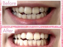 エクシアホワイトニング 姫路店/歯のビフォーアフター
