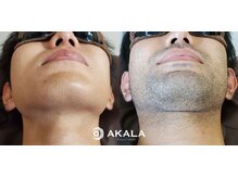 メンズ脱毛サロン アカラ(AKALA)