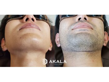 メンズ脱毛サロン アカラ(AKALA)の写真/【沖縄市メンズ脱毛専門店】通常の3倍の圧倒的な早さで効果を体感!青ヒゲとヒゲ剃りから最速で解放します!