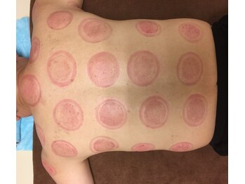 足浴堂/吸い上げられたカッピング痕