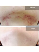 エミルカ(EMILUCA)/ハーブピーリングでお悩み改善