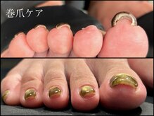 ネイル ミュー(nail myuu)/ジェルをしながら巻爪ケア☆