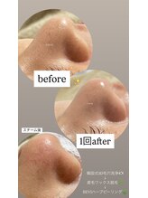 クレヴィー(Creviy)/韓国式3D毛穴洗浄＋ハーブ＋脱毛