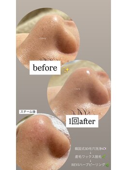 クレヴィー(Creviy)/韓国式3D毛穴洗浄+ハーブ+脱毛