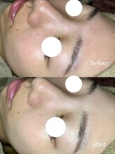 アルティ 福岡大名店(ARTI,)/水素毛穴洗浄