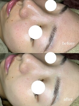 アルティ 福岡大名店(ARTI,)/水素毛穴洗浄