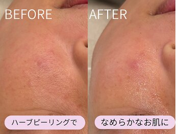 ケアズ(CARES)/ハーブピーリング