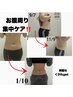 人気No.3★(お腹集中引き締め)お腹脂肪冷却1カップ+キャビ+脂肪分解剤