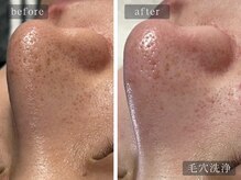 アムールサロン(Amour salon)/ハイドラ/毛穴洗浄/四谷三丁目