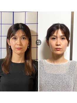 あらかき接骨院/【美容鍼】