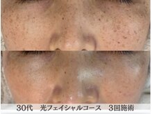 アリィ エステティック(allie esthetic)の雰囲気（長年お悩みだったシミがかなり少なくなりました。）