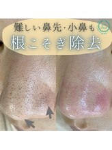 サロン リュンヌ(salon lune)/毛穴エクストラクション