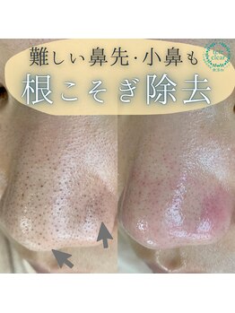 サロン リュンヌ(salon lune)/毛穴エクストラクション