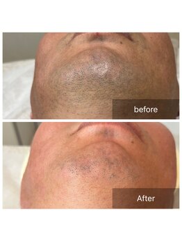 ビューティリュクス(beauty luxe)/お顔脱毛