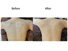 エミルカ(EMILUCA)/ハーブピーリングでお悩み改善