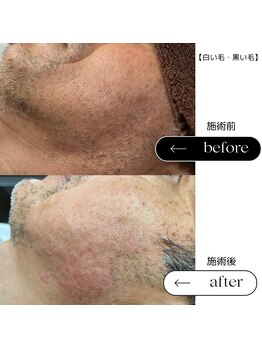 エスト(Est_.)/美容電気脱毛【白・黒い毛】