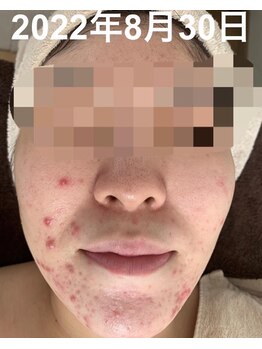 ナヴィータ アオバダイ(Navita AOBADAI)/エンビロン/2ヶ月集中コース