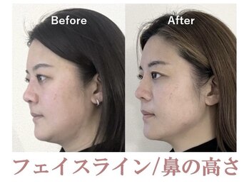 ラプリエイル 千葉店(Raplit aile)/ 隆鼻+輪郭矯正40分10回