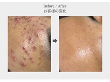 ベル 新橋(Belle)の雰囲気(【繰り返すニキビ】集中肌荒れコース|アクネ菌退治)