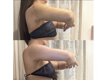 リボーン(boju reborn)の写真/【南森町/北浜 インディバ 】二の腕・脇肉を根こそぎ☆振袖肉×ハミ肉を徹底削り出し！スラッとした腕に◎