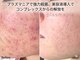 イノエ(inoe)の写真/【完全個室空間/医療提携/結果重視最新マシン★】素肌でも自信を☆イベントや大切な日に向けてのケアにも◎