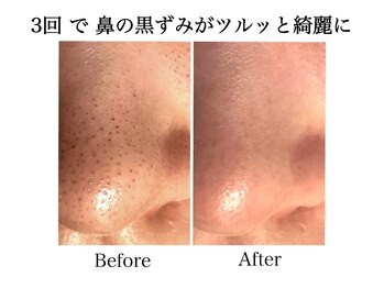 ナチュラーレ 天王寺店(Naturale)の写真/【祝27年☆4.8】1回で透明感の肌質を実感★毛穴洗浄ピーリング/小顔リンパ/天王寺駅2分