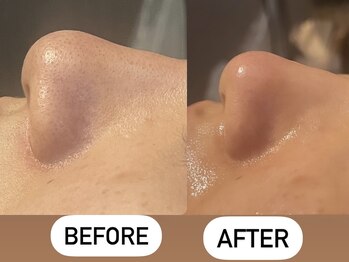 ソーレエルーナ(SOLE e LUNA)/小鼻黒ずみ 毛穴洗浄 ハイドラ