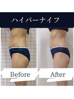 ハリルル 併設 GLケンタ鍼灸整骨院(HARILULU)/冷えにも効果的なハイパーナイフ