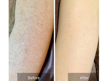 エミルカ(EMILUCA)/ハーブピーリングでお悩み改善