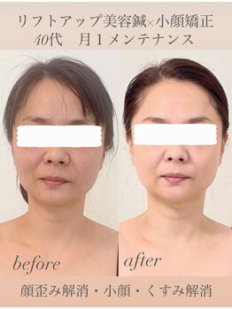 めい鍼灸院/リフトアップ美容鍼×小顔矯正