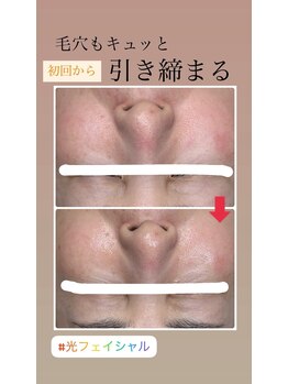 顔凛(カオリン)/毛穴もキュッと改善