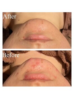 エミルカ 鹿児島店(EMILUCA)/ハーブピーリング 顔