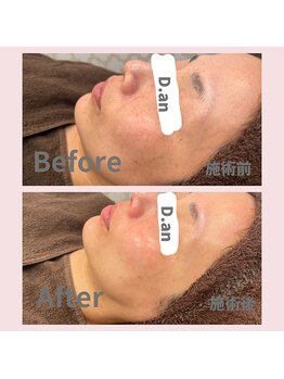 ディードットアン(D.an)/ハーブピーリング