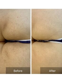 エミルカ(EMILUCA)/ハーブピーリングでお悩み改善