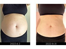 ラグラン銀座メディカルエステ 高輪ゲートウェイ店/【BODY】セルマジ・ビフォアフ