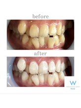 ホワイトニングショップ 町田店/【ビフォーアフター】10回