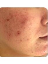 お顔そりローズマリー/ハーブピーリング