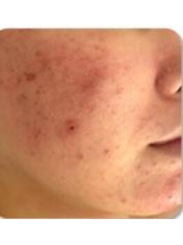 お顔そりローズマリー/ハーブピーリング