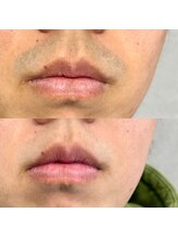 ルチルス(Rutiles)/ヒゲ脱毛/ 学生専用コース有り