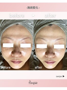 フレク(fleque)/ハーブピーリング☆くすみ飛ばし