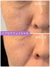 プリュネル(Prunelle)/プラズマシャワー