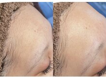 潤艶Wax＆シルキー糸脱毛でくすみも消え、化粧ノリが格段にUP！